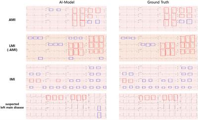 ECG data analysis to determine ST-segment elevation myocardial infarction and infarction territory type: an integrative approach of artificial intelligence and clinical guidelines